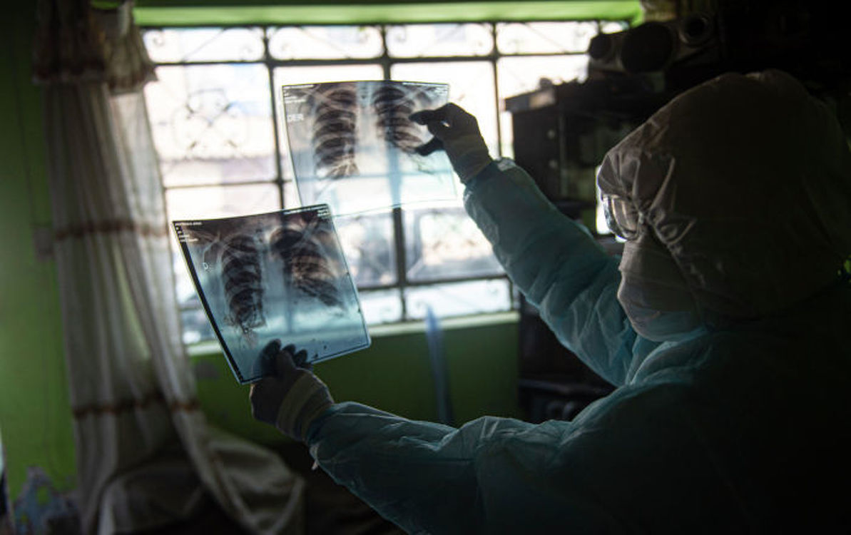 Еще 32 человека умерли от пневмонии в Кыргызстане — всего 382 — Today.kg