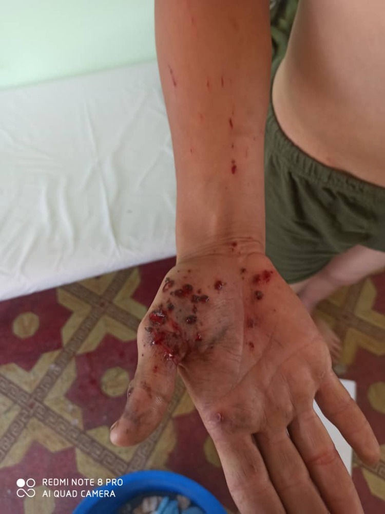 В Айдаркене пограничник по неосторожности получил ранение гранатой — Today.kg
