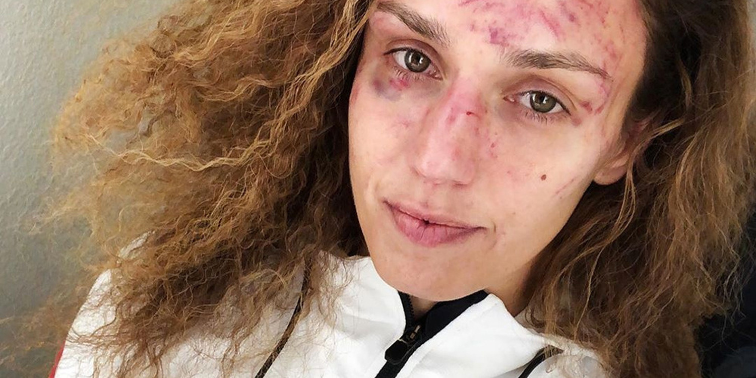Антонина Шевченко показала лицо после 45 пропущенных ударов в голову от Кэтлин Чукагян — Today.kg