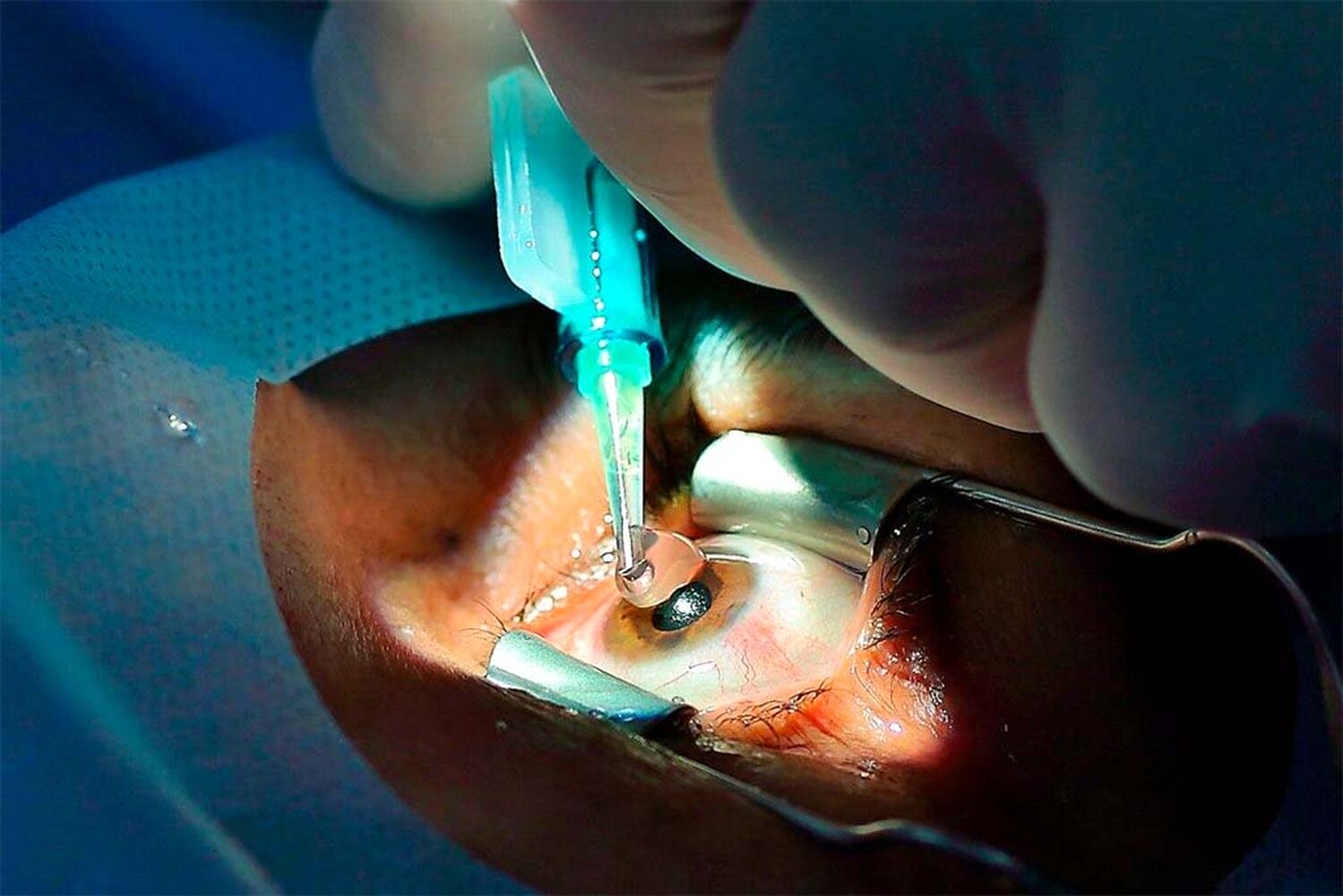 Китайские врачи проведут 600 операций по удалению катаракты глаза — Today.kg