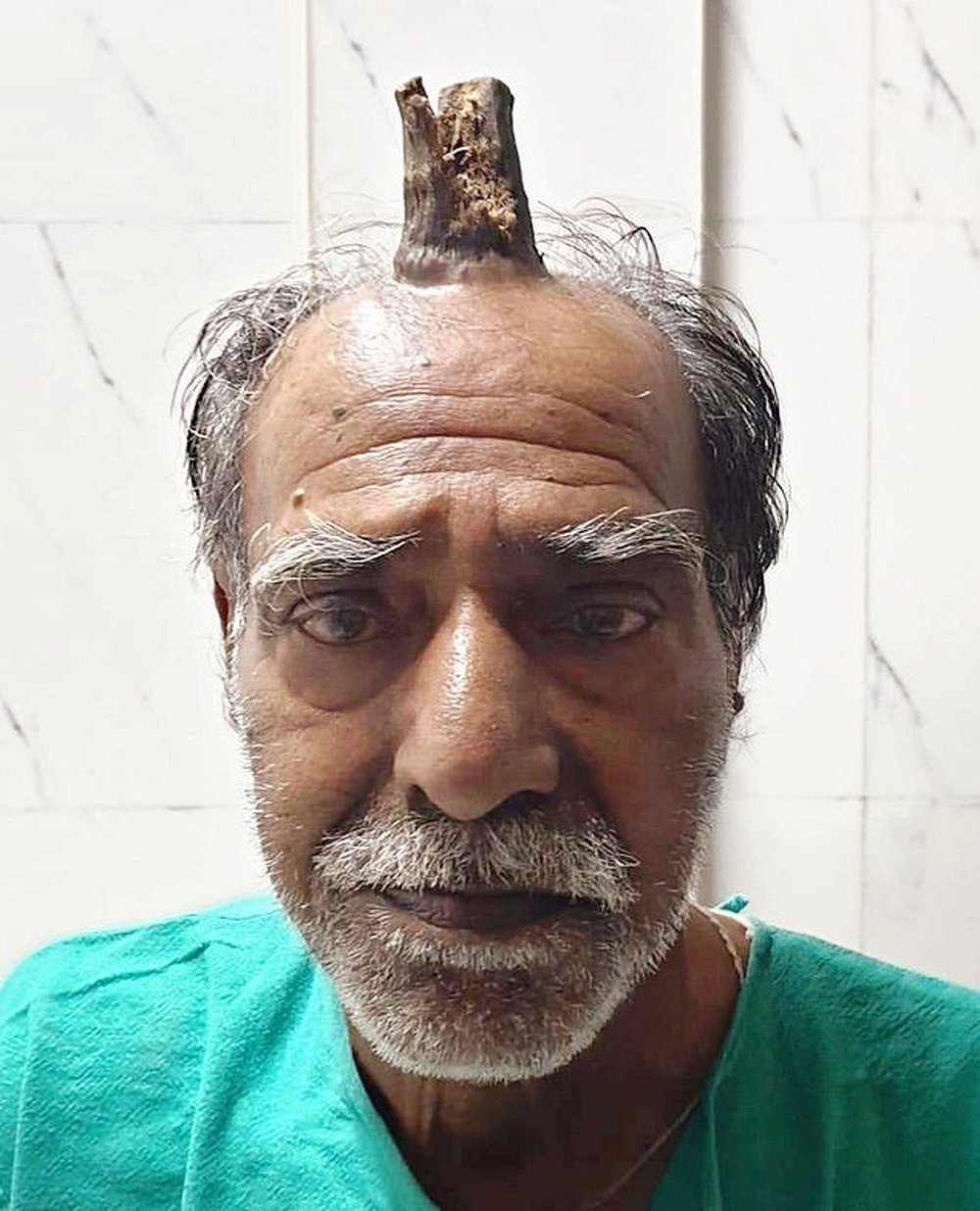 В Индии мужчине удалили 10-сантиметровый рог — шокирующее фото — Today.kg