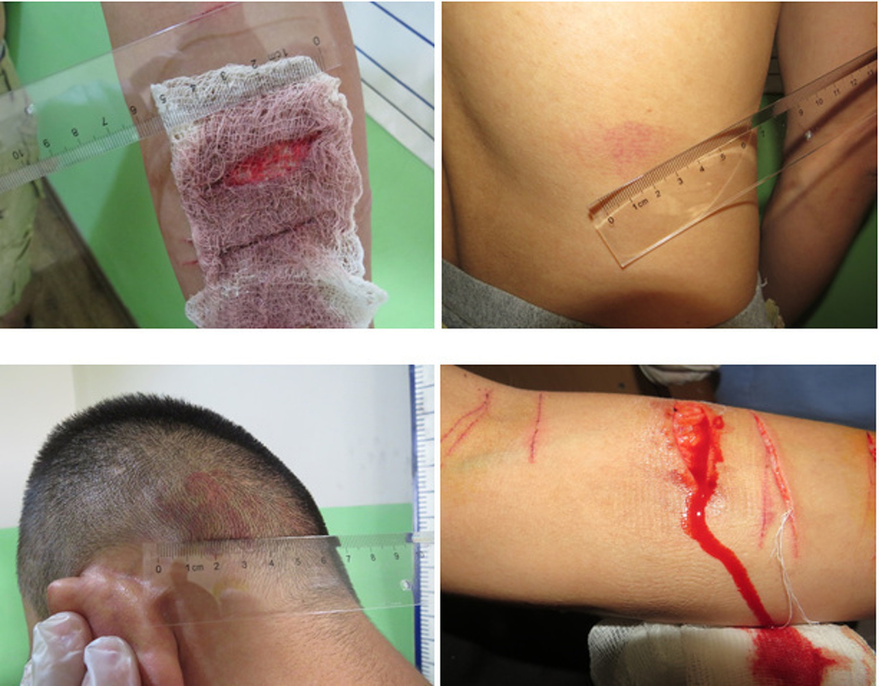 Наццентр против пыток: В Бишкеке задержанный порезал себе руки в ИВС (осторожно, фото) — Today.kg