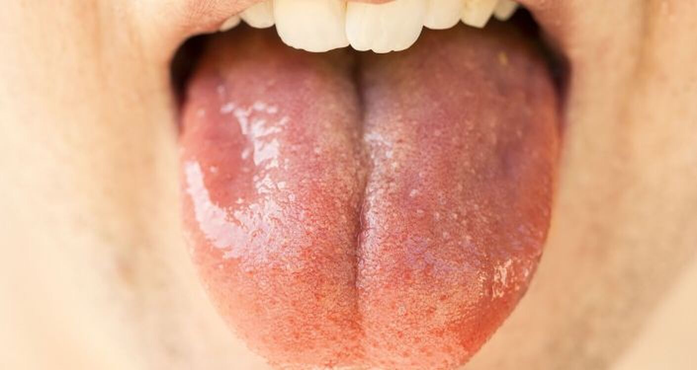 Потолстевший и гладкий язык может быть признаком опасной болезни — ученые — Today.kg
