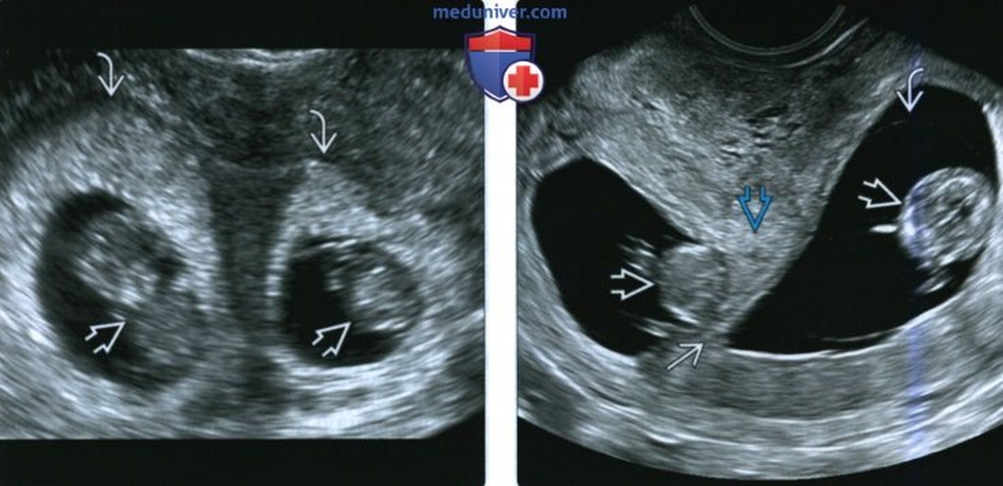 Монохориальная двойня. Дихориальная диамниотическая двойня УЗИ. Бихориальная биамниотическая двойня УЗИ. Монохориальная моноамниотическая двойня УЗИ. Монохориальная беременность двойней.